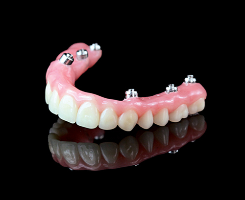 Hybrid Denture